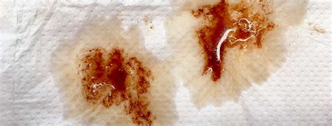 thick brown discharge after smear test|brown discharge symptoms pictures.